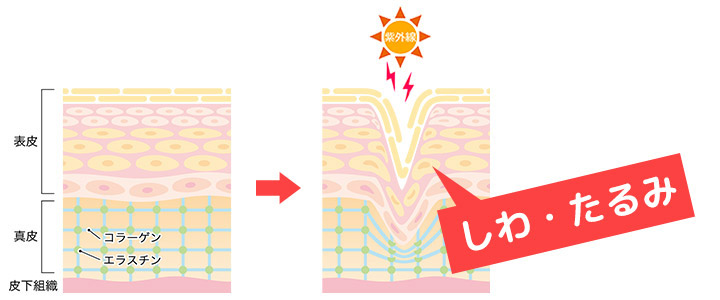 紫外線によるしわの原因