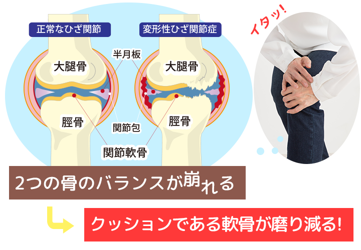 膝痛画像