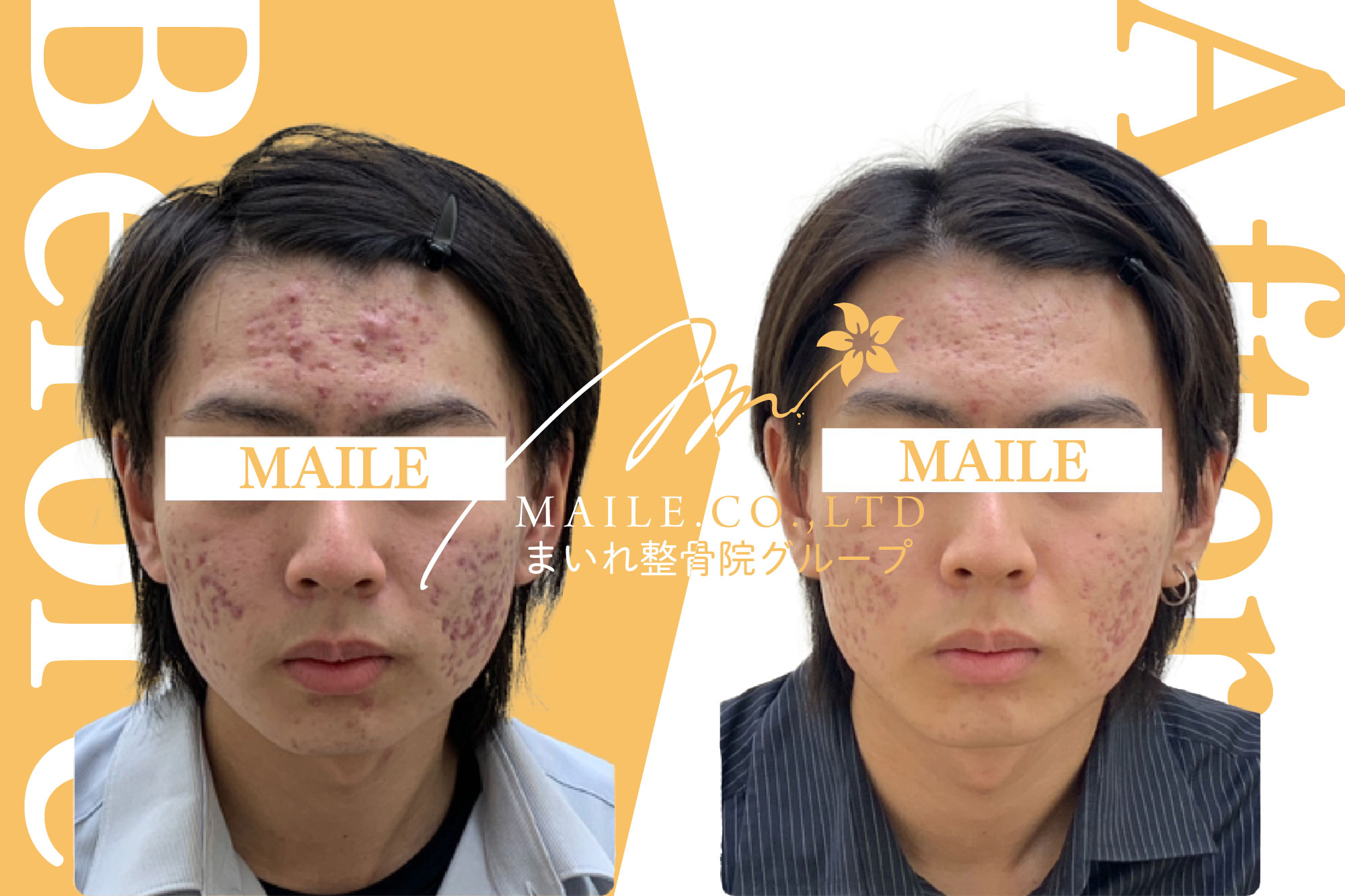 大津市石山|美容鍼ビフォーアフター