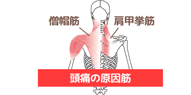 頭痛画像
